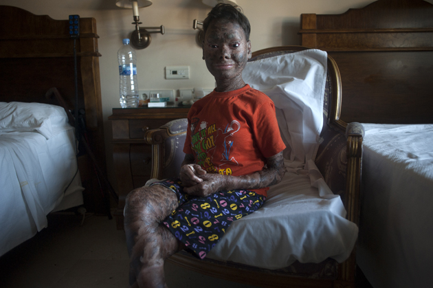 Shalini Yadav, 16, known as the "snake girl" poses in Marbella on September 15, 2017.  Shalini, who suffers recessive lamellar ichthyosis and sheds her skin every six weeks due to a rare condition, is to get life-improving treatment in southern Spain. / AFP PHOTO / JORGE GUERRERO