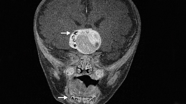 Hallan dientes en el cerebro de un bebé