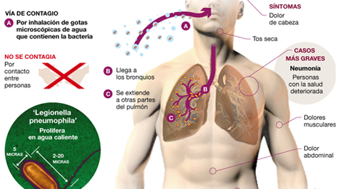 Legionelosis