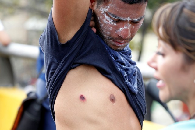 A demonstrator shows an injury caused by rubber bullets fired by the police during an opposition rally in Caracas, Venezuela, April 6, 2017. REUTERS/Christian Veron