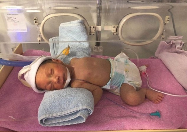 Bebé Que Nació Con Dos Cabezas En Siria Fue Operado Con éxito Fotos 5546