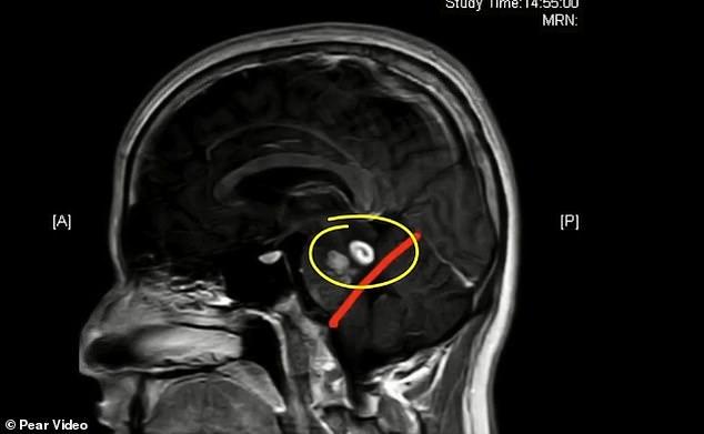 Tuvo un gusano en el cerebro por 15 años por tomar un remedio casero