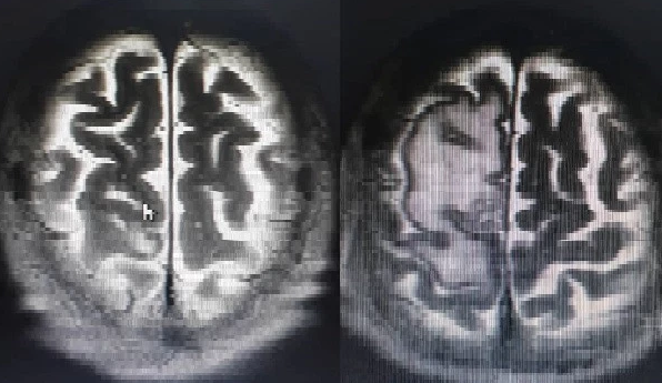 Nuevo tratamiento de radioterapia hipofraccionada elimina las metástasis cerebrales