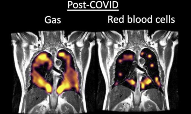 Expertos reiteran cuáles son las consecuencias del coronavirus en el cuerpo