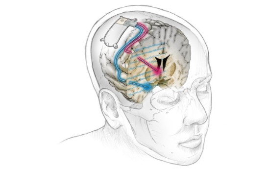 Realizaron el primer implante exitoso de un “marcapasos cerebral” para tratar la depresión severa