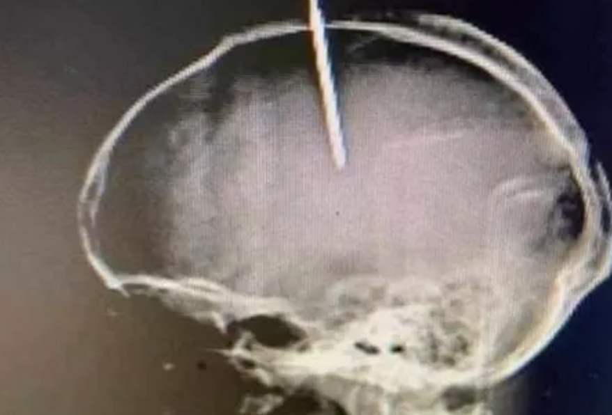 Extraen clavo que un hombre se incrustó en la cabeza porque sentía su “cerebro flojo” (FOTO)