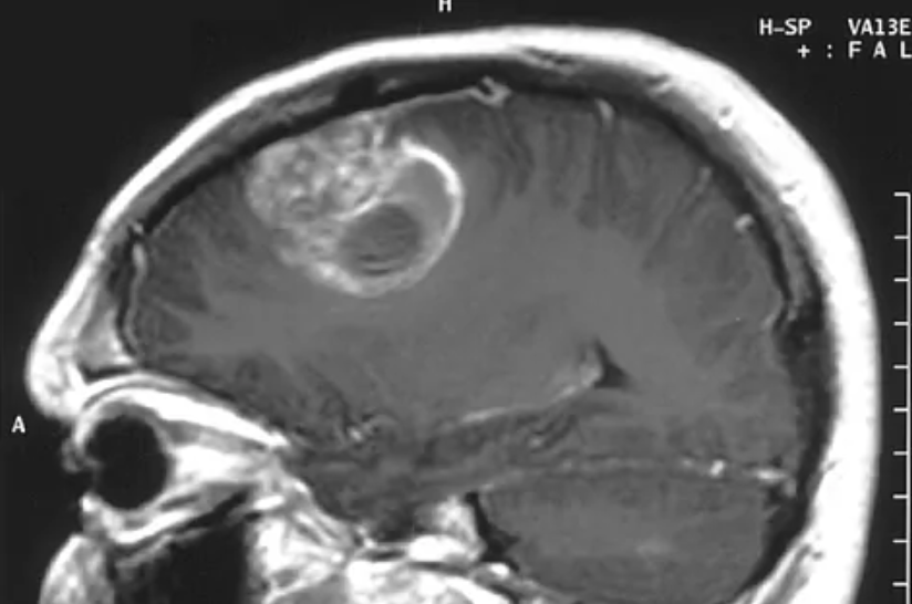 Lograron que la quimioterapia penetre en el cerebro contra un tumor mortal