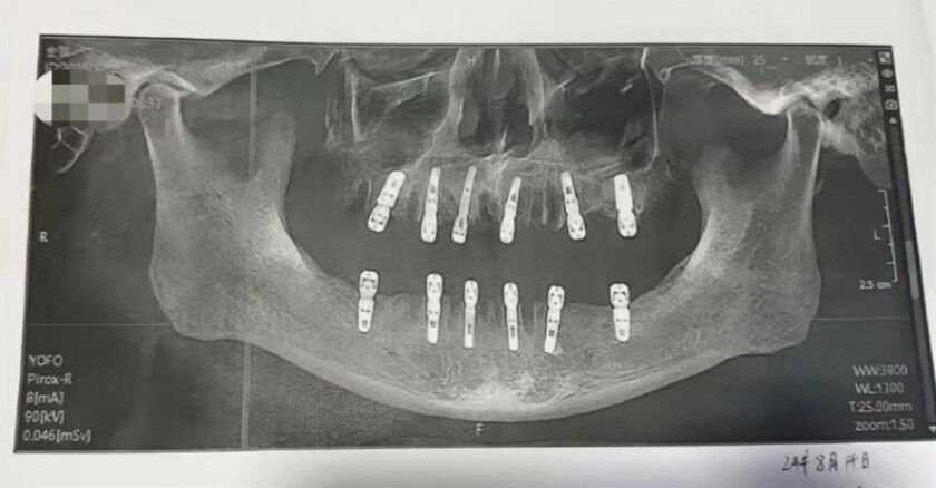 Le extrajeron 23 dientes de una vez y a los días murió