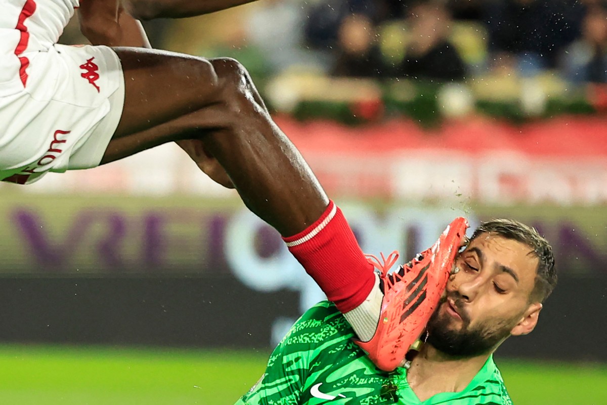 Así quedó la cara de Donnarumma tras el brutal planchazo que sufrió ante Mónaco (imagen sensible)